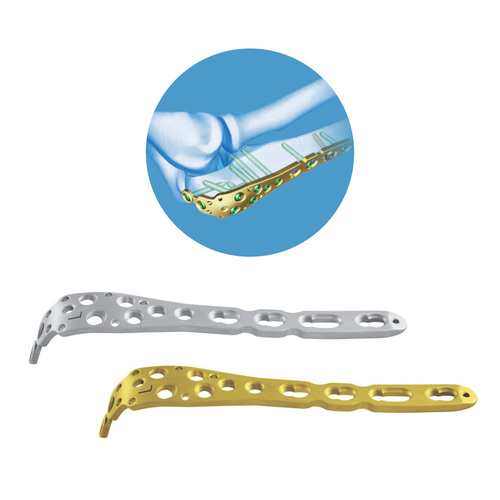 Locking Olecranon Plate