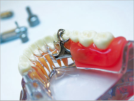 Dental Implant Services