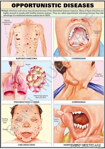 Opportunistic Diseases Chart - Polyart Synthetic Paper 70x100 cm, Visual Learning AIDS Complications Educational Tool