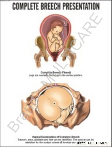 Complete Breech Presentation Chart