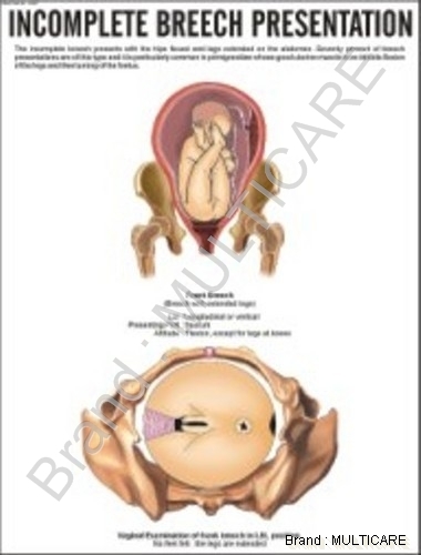 Incomplete Breech Presentation Chart