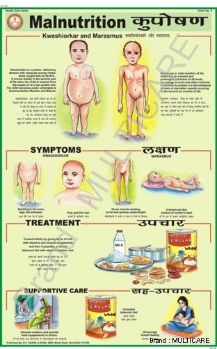 Malnutrition Chart