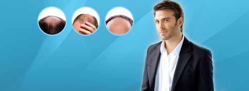 Cost Effective Best Natural Hair Fixing Procedure - Silicon Material, Non-Surgical, Painless, Instant Results
