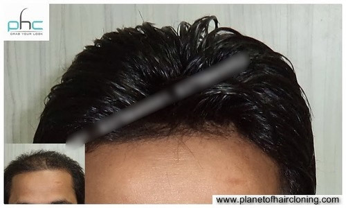 New Delhi # Permanent Hair Transplant Side effects