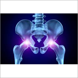 Hip Replacement