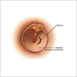 Tympanoplasty Surgery