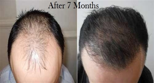 Hair Replacement in Delhi