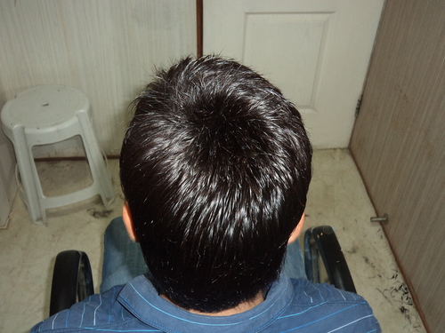 Hair Replacement in Gurgaon