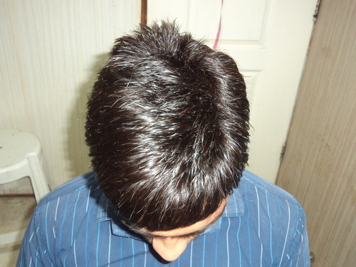 Hair Replacement in Faridabad