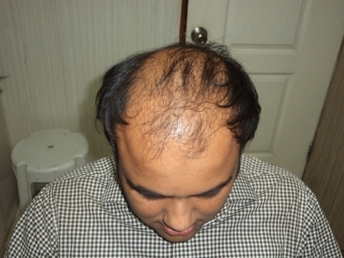 Hair Fixing in Delhi