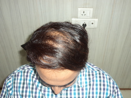 Hair Fixing in Faridabad
