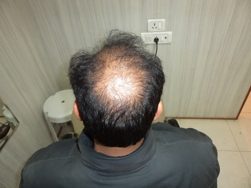 Cost of Wigs in Delhi