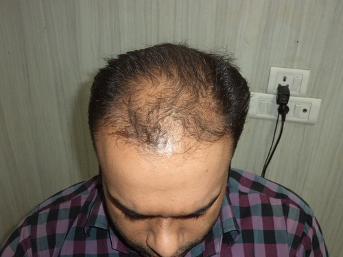 Hair Wigs for Men in Gurgaon