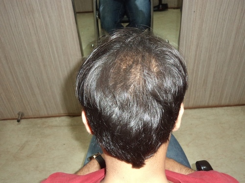 Hair patch for Men in Delhi