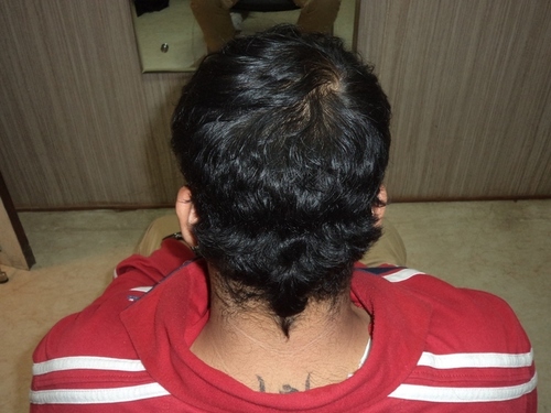 Hair Patch for Men in Noida