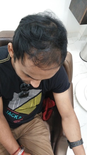 Hair Patches for Men