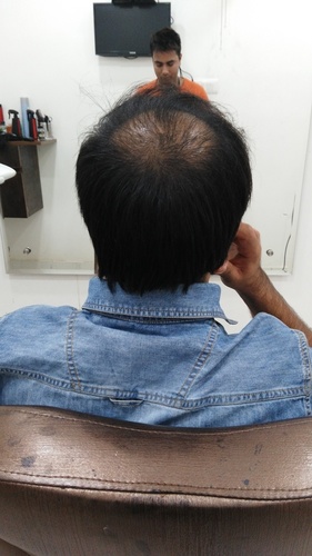 Non Surgical Hair Replacement Cost in Delhi