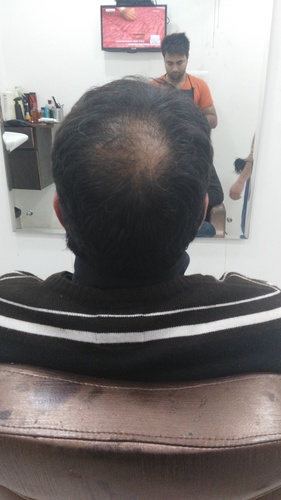 Non Surgical Hair Replacement in Noida
