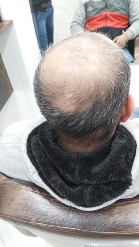 Non Surgical Hair Replacement in Gurgaon