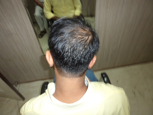 Hair Weaving Clinic in Delhi