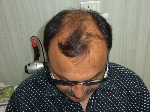 Hair Weaving Cost In Delhi For Men Fusion Hair Transplant T 136