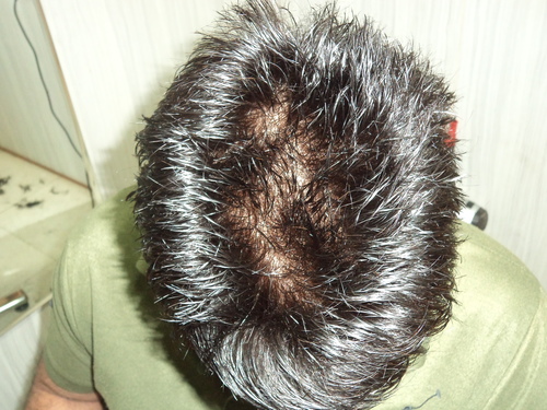 Cost of Hair Weaving in Delhi