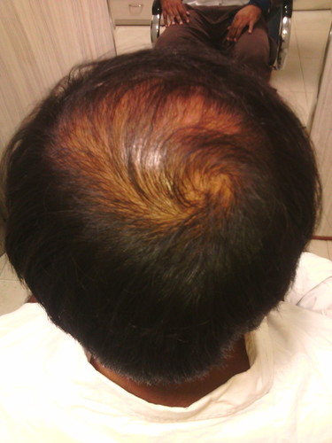 Hair Weaving In Delhi Cost Fusion Hair Transplant T 136 5 Abc