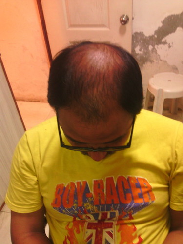 Hair Weaving In New Delhi Fusion Hair Transplant T 136 5 Abc