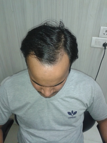 Hair System