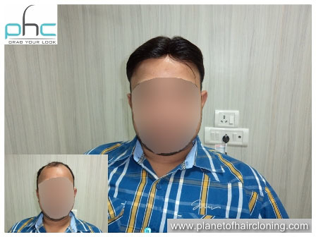 Hair Replacement System in Delhi