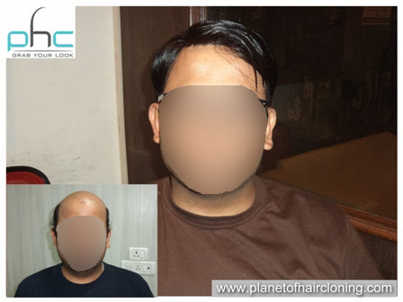 Hair Replacement for Men
