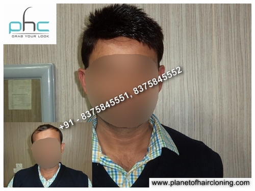 Hair Replacement for Women