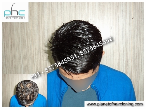 Artificial Hair Replacement for Men