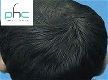 Non Surgical Hair Replacement Systems