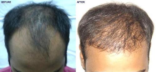 Hair Bonding in Delhi Ncr - Variable Duration, FUE/FUT Technique, Multiple Sessions | Hair Regrowth, Improved Density, Natural Look, Long-Lasting