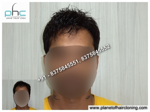 Good Hair Bonding Hair Transplant Center Hair Care Treatment Doctors in