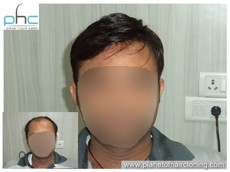 Side effect of Hair Silicon Bonding glue