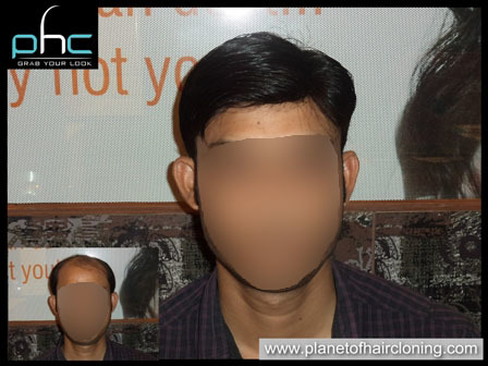 Non surgical hair replacement side effects