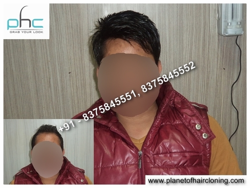 Hair Replacement systems disadvantages