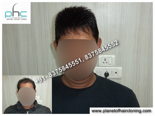 Men's Hair Patch side effects