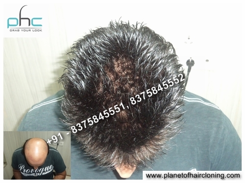 Non Surgical Hair Replacement Services in Delhi