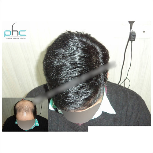 Hair Replacement Services in Delhi India