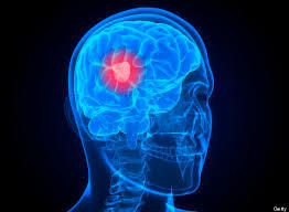 Brain Tumors Treatment