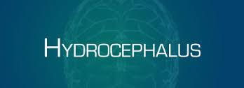 Hydrocephalus Treatment