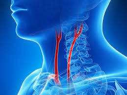 Carotid Artery Disease