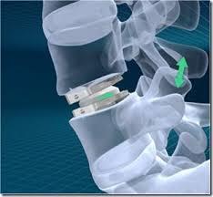 Neuro and Spine Surgeries