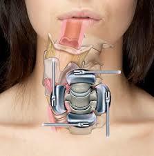 Cervical Surgery