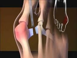 Bunion Surgery