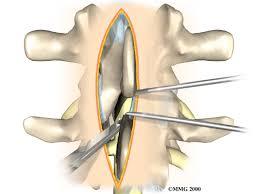 Fusion Surgery
