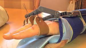 Tendon Repair